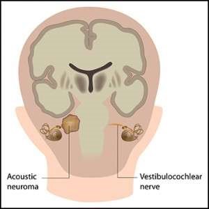 Acoustic Neuroma/Vestibular Schwannoma